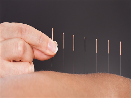 acupuncture-pic