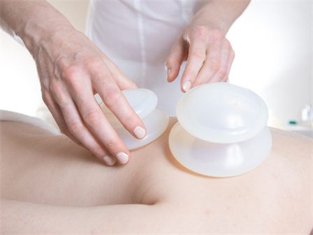 cupping_img-1024x683